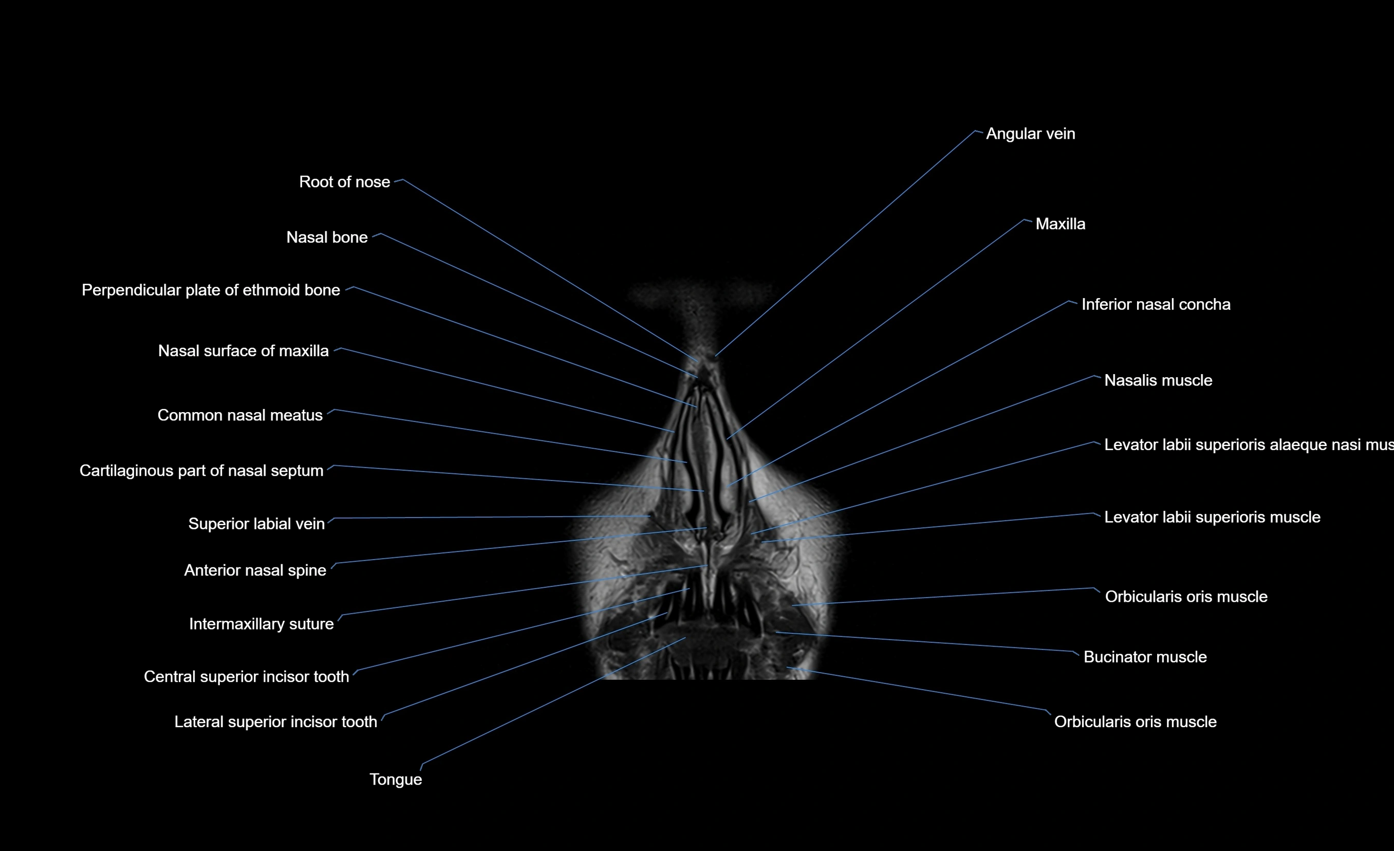 MRI face & paranasal sinuses(PNS) labelled  coronal  cross sectional anatomy 3T radiology  image-img-00001-00010.webp